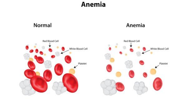 Anemia Profile
